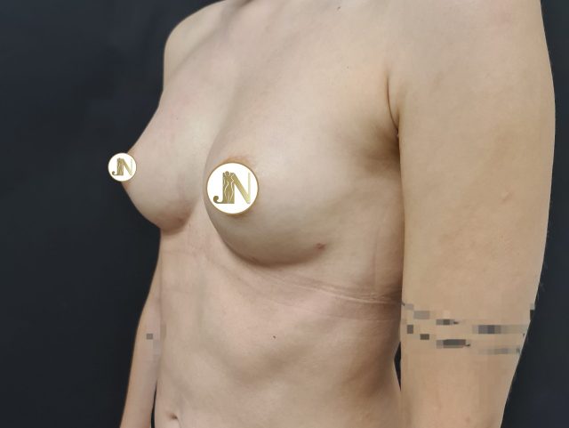 povecanje-vlas-tkivom3